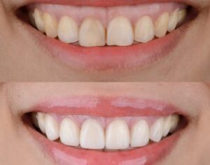 Gummy- Smile zu viel Zahnfleisch sichtbar