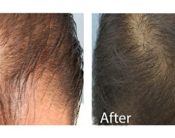 PRP-Behandlung der Haare: Vorher- Nacher