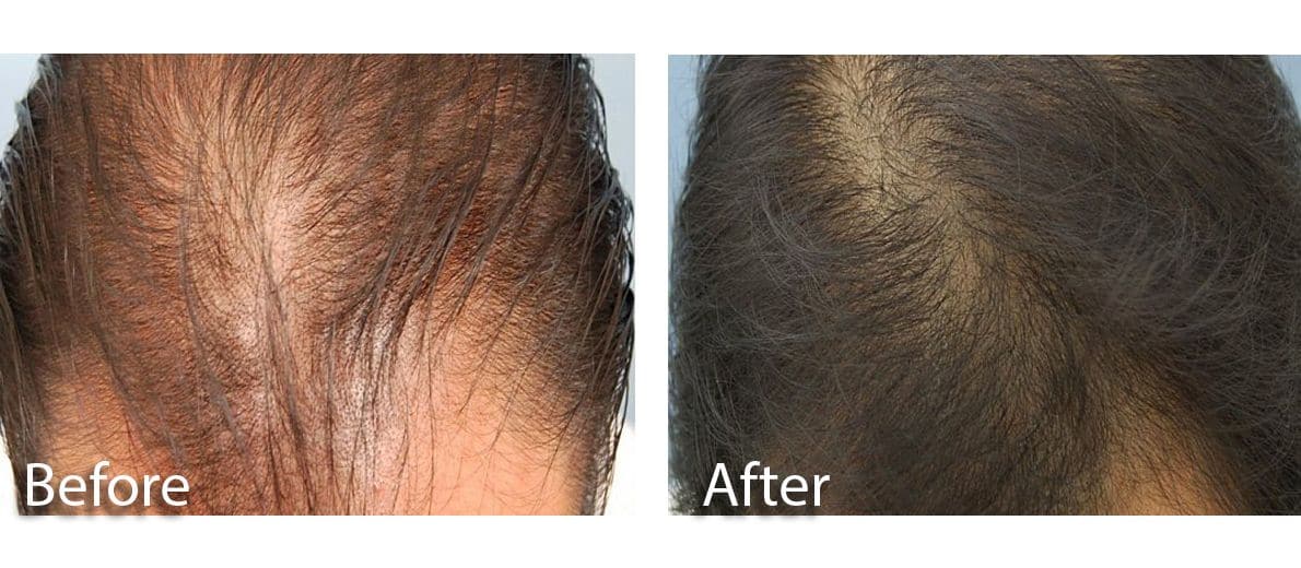 PRP-Behandlung der Haare: Vorher- Nacher