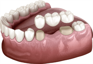 4.4. Restoration with a traditional dental bridge for the posterior teeth