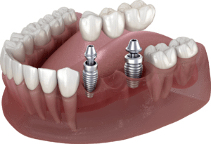 4.6. Restoration with a dental bridge supported on titanium implants