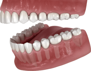 5.2. The posterior teeth are restored with four Patent™ implants